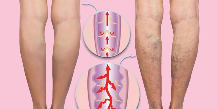 zdravé a křečové žíly na nohou